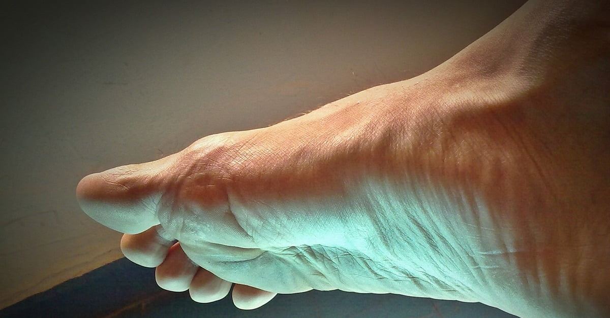 πελματιαία απονευρωσίτιδα