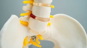 lumbar-spine-displaced-herniated-disc-fragment-sp-2023-08-02-19-56-53-utc - Human Kinetics Πρόκειται για ένα μοντέλο ανθρώπινης σπονδυλικής στήλης με έμφαση στους σπονδύλους και τα μεσοσπονδύλια δίσκους.