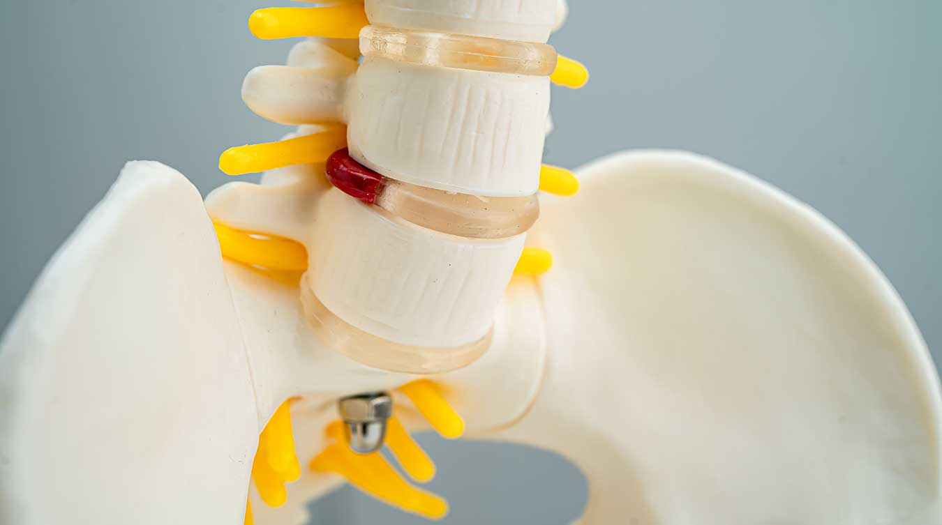 Πρόκειται για ένα μοντέλο ανθρώπινης σπονδυλικής στήλης με έμφαση στους σπονδύλους και τα μεσοσπονδύλια δίσκους.