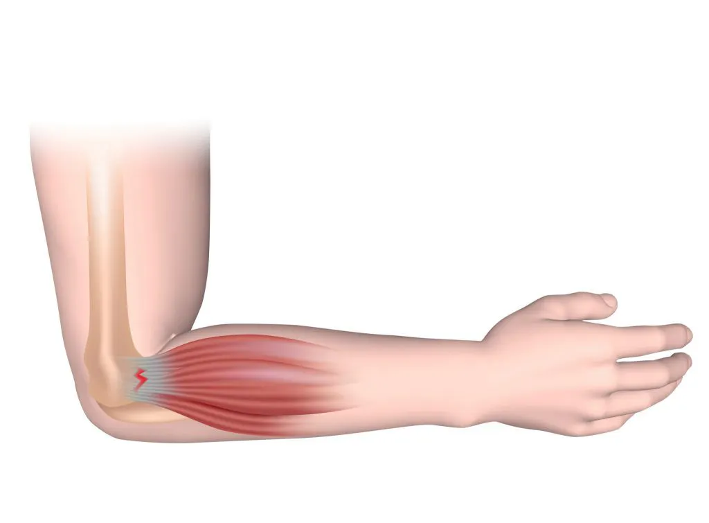tennis-elbow - Human Kinetics - Human Kinetics tennis-elbow